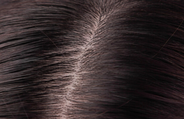 A close-up of a healthy scalp and a dry scalp
